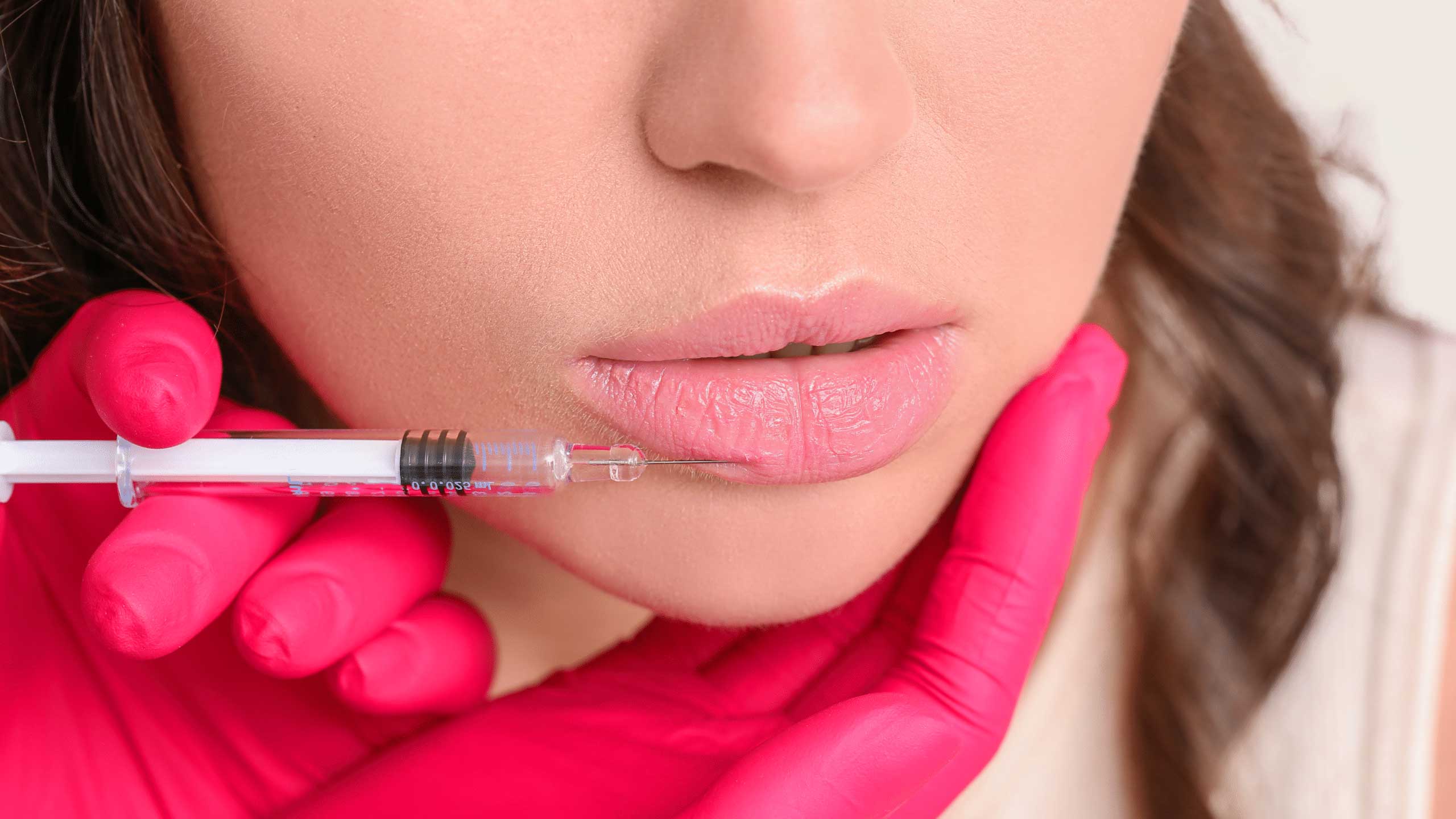 Natural lip filler enhancement